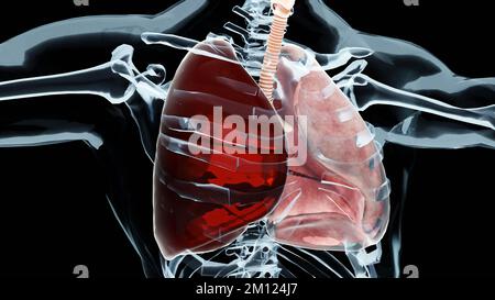 3D Illustration des Hämatothorax, normale Lunge versus kollabiert, Symptome des Hämatothorax, Pleuraerguss, Empyem, Komplikationen nach einer Brustverletzung, ai Stockfoto