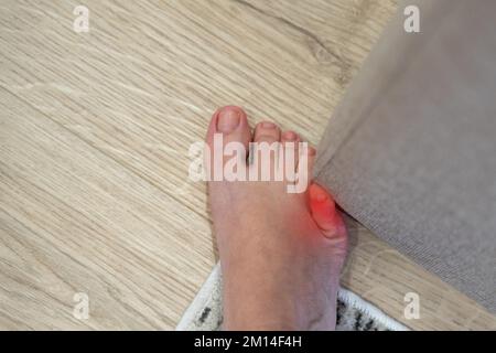 Die Frau hat die Möbel mit dem kleinen Zeh getroffen. Vorfall zu Hause. Roter Fleck mit Verletzung eines kleinen Fußfingers Stockfoto