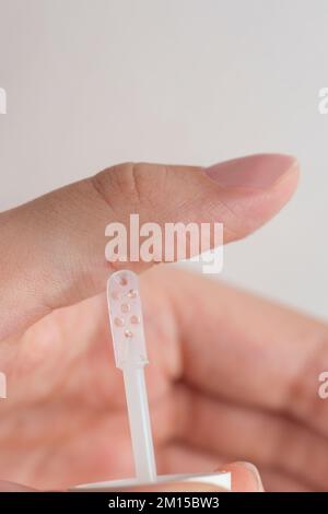 Warzenbehandlung. Der Arzt trägt das Arzneimittel mit einem speziellen Spachtel auf die Warze auf. Beseitigung einer gutartigen Bildung auf der menschlichen Haut mit einem Stockfoto