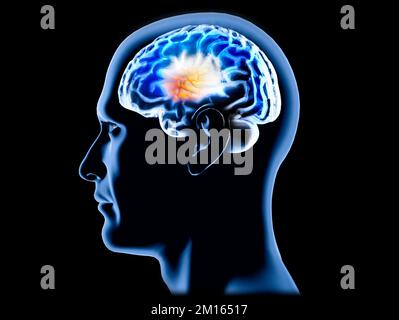 Ein Teil des Gehirns im Profil, Teile des Gehirns. Degenerative Erkrankungen, Parkinson, Synapsen, Neuronen, Alzheimers. Silhouette eines Männergesichts Stockfoto