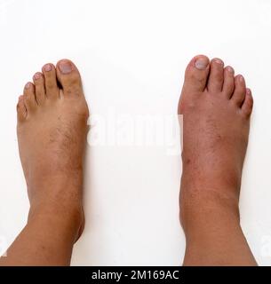 Fußvergleich zwischen einem gesunden Fuß und einem Fuß, der durch eine Gichtanfall geht. Der Fuß mit Gicht ist rot und sichtbar geschwollen. Stockfoto
