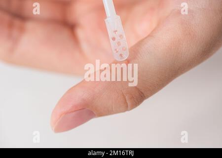 Warzenbehandlung. Der Arzt trägt das Arzneimittel mit einem speziellen Spachtel auf die Warze auf. Beseitigung einer gutartigen Bildung auf der menschlichen Haut mit einem Stockfoto