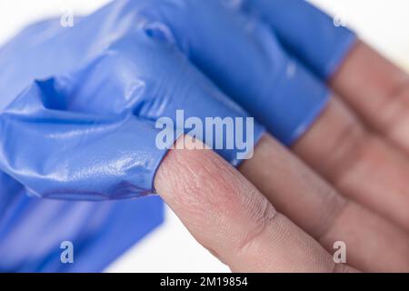Der Arzt zieht seine blauen Gummihandschuhe aus, die Haut an seinen Händen ist durch Feuchtigkeit zerknittert. Zerknitterte Finger nach längerem Tragen von Gummihandschuhen Stockfoto