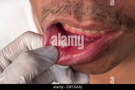 Aphthöses Ulkus, Wunde Krebse oder Stressulkus im Mund eines asiatischen männlichen Patienten. Stockfoto