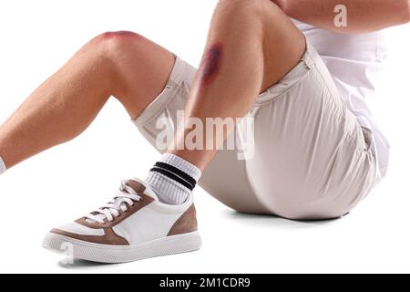 Mann mit Bluterguss am Bein vor weißem Hintergrund Stockfoto