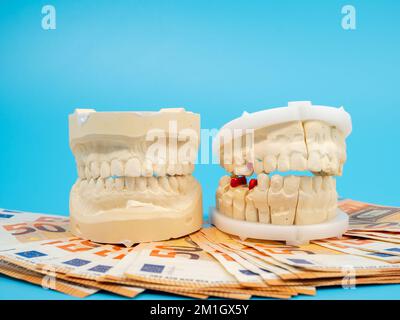 Zahngips und Banknoten auf blauem Hintergrund. Gipsmodell der Zähne. Nahaufnahme. Stockfoto