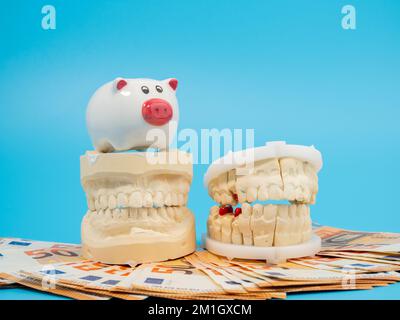 Zahngips, Sparschwein und Banknoten auf blauem Hintergrund. Gipsmodell der Zähne. Nahaufnahme. Stockfoto