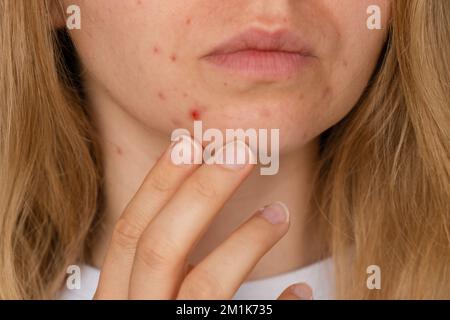 Nicht erkennbare Frau, die ihre Akne im Gesicht zeigt. Nahaufnahme Akne auf dem Gesicht der Frau mit Hautausschlag, Narbe und vor Ort, die allergisch auf Kosmetika. Problem Hautpflege und Gesundheitskonzept. Falten, Melasma, dunkle Flecken, Sommersprossen, trockene Haut, Akne Mitesser auf Gesicht mittleren Alters Frauen Kinn Akne Problem. Pickel auf dem Bart. Problem Haut in einem jungen Mädchen. Hormonelle Fehlbalance. Hauterkrankungen führen bei Frauen zu Depressionen und Unsicherheiten Stockfoto