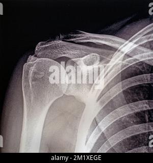 Altes Röntgenbild aus der Mitte des 20.. Jahrhunderts/Röntgenbild mit Schultertendinitis/Tendinopathie, Sehnenentzündung Stockfoto