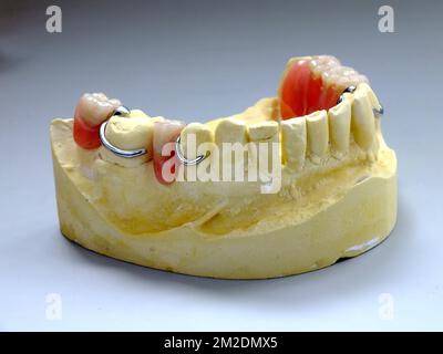 Zahnersatz | Prothèse dentaire emprinte en platre et prothèse 13/03/2018 Stockfoto