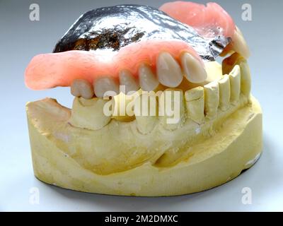 Zahnersatz | Prothèse dentaire emprinte en platre et prothèse 13/03/2018 Stockfoto