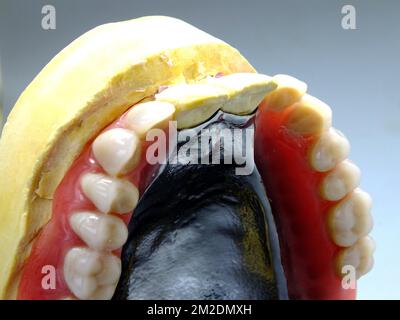 Zahnersatz | Prothèse dentaire emprinte en platre et prothèse 13/03/2018 Stockfoto