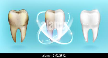 Clean and dirty tooth, whitening and clearing teeth process. Dental and oral cavity health care, enamel restoration, toothpaste advertising isolated on blue background Realistic 3d vector illustration Stock Vector