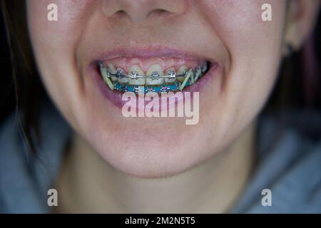Metallklammern an den Zähnen schließen. Lächeln Sie mit einer Zahnspange. Konzept der zahnärztlichen Betreuung und kieferorthopädischen Behandlung Stockfoto