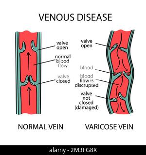 VENENERKRANKUNGEN-SCHEMA Varizen menschlicher Beine Verdrehen und Dilatation der Blutgefäße Schematische Darstellung der Veränderungen in Körperteilen Medical Ed Stock Vektor