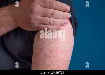 Erysipel - Nahaufnahme an der Hand. Am Unterarm erscheint ein roter Ausschlag. Stockfoto