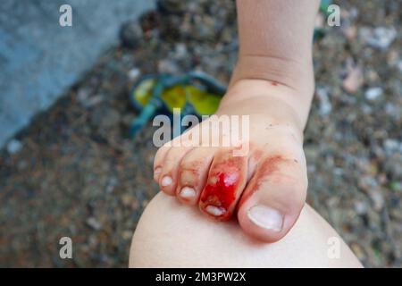 Ein Kind hat einen verletzten Zeh. Blut vom Schnitt Stockfoto