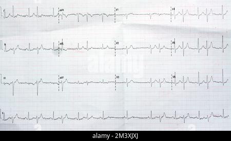 EKG-EKG-Papier, das den normalen Sinusrhythmus NSR mit häufigen PACS ...