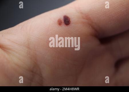 Ein Fehler in der Haut an der Hand der Handfläche. Bluterguss an der Handfläche. Hautschäden. Menschliche Haut Hand Gesundheit Stockfoto