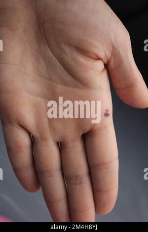 Ein Fehler in der Haut an der Hand der Handfläche. Bluterguss an der Handfläche. Hautschäden. Menschliche Haut Hand Gesundheit Stockfoto