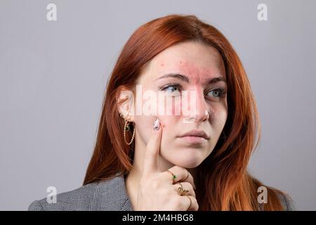 Junges hellhäutiges Mädchen mit Akne-Rosazea auf Gesichtshaut. Symptome einer Coupose mit Rötung der Wangen und Nase Stockfoto