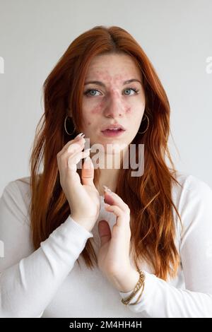 Junge Weiße mit allergischer Reaktion durch Bienenstich im Gesicht. Rötung und Juckreiz im Gesicht. Gefahr des anaphylaktischen Schocks Stockfoto