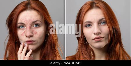Vor und nach einer Rosazea-Laserbehandlung. Erfolgreiche Entfernung von Couperose aus dem Gesicht einer jungen Frau. Rote Wangen aus entzündeten Kapillaren einer A. Stockfoto