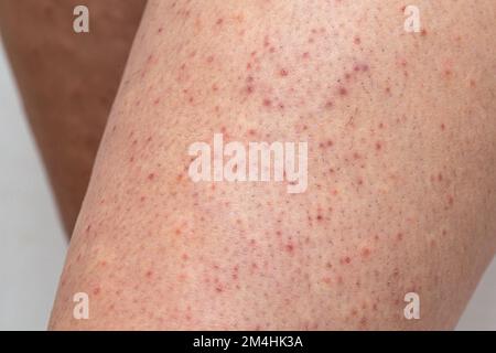 Legskin-Makro einer jungen Frau mit Säulenkeratose, häufige Ursache einer atopischen Dermatitis und Sketchy Stockfoto