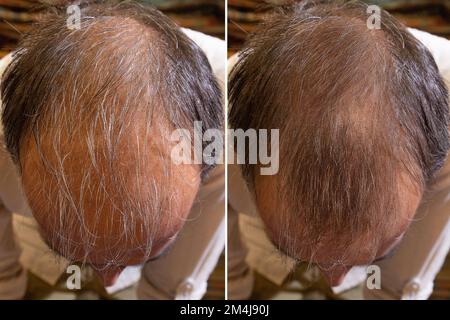Draufsicht, vor und nach Glatzbehandlung. Details des Haares eines Mannes mit Ausdünnung und Ausdünnung der Kopfhaut Stockfoto