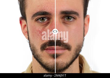 Kaukasisches männliches Gesicht mit roter Rosazea der Haut vor und nach Couperose-Behandlung Stockfoto