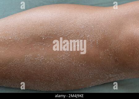 Weibliches Bein mit trockener Haut und Dehydrierungsproblemen. Ausgeprägte Hautabschuppung. Stockfoto