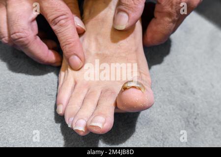 Nahaufnahme eines barfuß-Mannes mit einem gelben und dicken Grossnagel, Onychomykose, einer Pilzinfektion der Zehennägel. Stockfoto