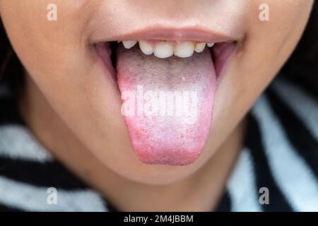 Nahaufnahme einer Zunge eines kleinen Mädchens mit bakterieller Patina durch schlechte Mundhygiene oder schlechte Ernährung. Stockfoto