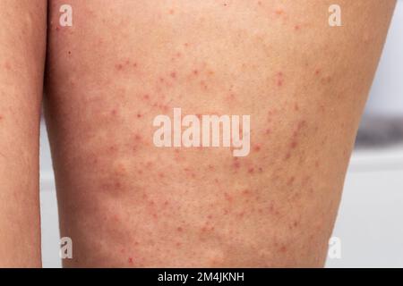 Nahaufnahme von Frauenbeinen mit Keratosis pilarar, einer akuten Follikulitis, die punktgenaue Rötung hervorruft, dermatologisches Versorgungskonzept Stockfoto