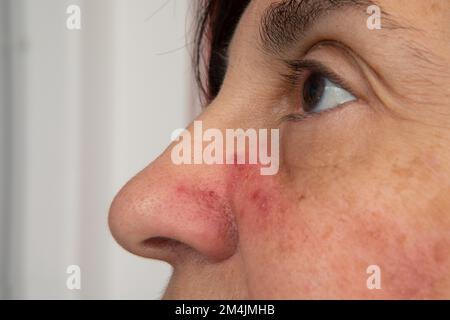 Weibliches Gesicht mit roter Haut und Pusteln in der Nähe der Nase. Akne-Rosazea-Konzept Stockfoto