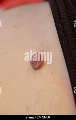 Große geschwollene Leberflecken auf der Haut einer Frau Stockfoto