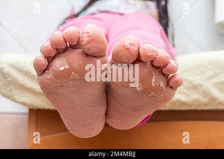 Ein Fall von extremer Exfoliation an Kinderfüßen, wahrscheinlicher Sportlerfuß, Tinea pedis, Dermatitis durch Dermatophytenpilze durch Schweissstillstand. Stockfoto