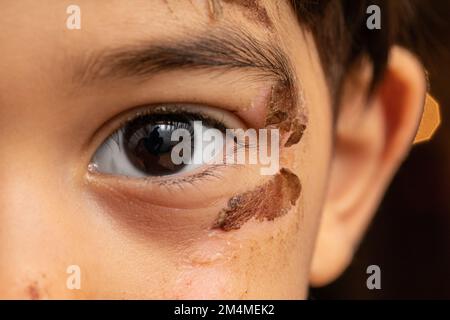 Makro eines kindlichen Auges mit Abschürfungen in Tempelnähe. Krusten, die sich ablösen, und sichtbare Narben. Der Begriff der Verletzungsgefahr im Kindesalter. Stockfoto