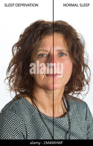 Auswirkungen von Schlafentzug auf das Gesicht einer Frau, Vergleich vor und nach Schlafentzug und normaler Ruhe Stockfoto