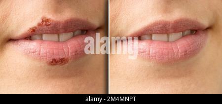 Lippenverschlüsse einer Frau vor und nach Lippenherpes-Behandlung, Herpes simplex. Detail mit und ohne Narbe und Pusteln Stockfoto