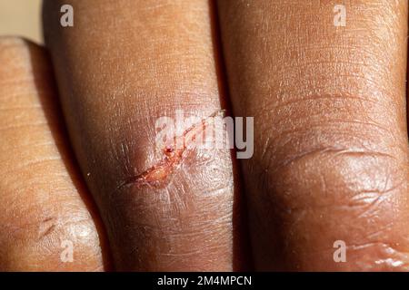 Makroansicht menschlicher Handfinger mit einfach geschnittener offener Wunde im Freien. Infektionsgefährdungskonzept Stockfoto