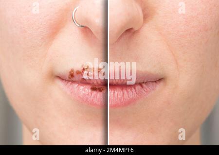 Lippenverschlüsse einer Frau vor und nach Lippenherpes-Behandlung, Herpes simplex. Detail mit und ohne Narbe und Pusteln Stockfoto