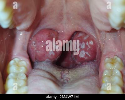 Mandeln. Angina Pectoris. Tonsillitis. Bakterielle Erkrankung, die in den Mandeln produziert wird und Schwellungen und Plaque verursacht. Schlechter Mund. Eiter auf den Mandeln. Fotografie. Stockfoto