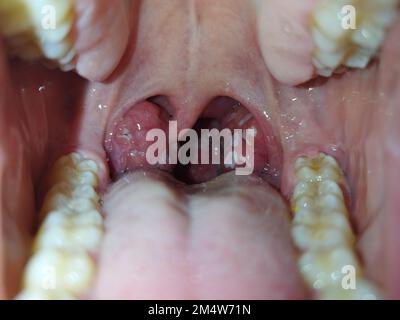 Mandeln. Angina Pectoris. Tonsillitis. Bakterielle Erkrankung, die in den Mandeln produziert wird und Schwellungen und Plaque verursacht. Schlechter Mund. Eiter auf den Mandeln. Fotografie. Stockfoto