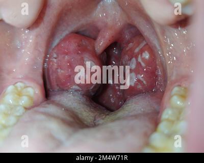 Mandeln. Angina Pectoris. Tonsillitis. Bakterielle Erkrankung, die in den Mandeln produziert wird und Schwellungen und Plaque verursacht. Schlechter Mund. Eiter auf den Mandeln. Fotografie. Stockfoto