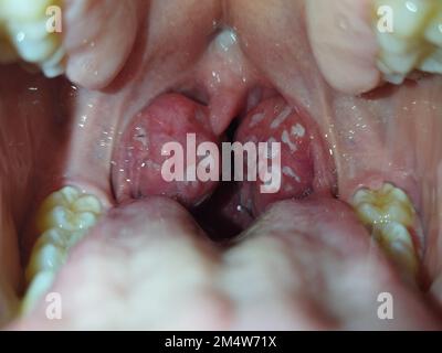 Mandeln. Angina Pectoris. Tonsillitis. Bakterielle Erkrankung, die in den Mandeln produziert wird und Schwellungen und Plaque verursacht. Schlechter Mund. Eiter auf den Mandeln. Fotografie. Stockfoto