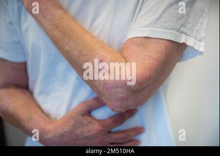 Hauterkrankung Psoriasis an Arm und Hand Stockfoto