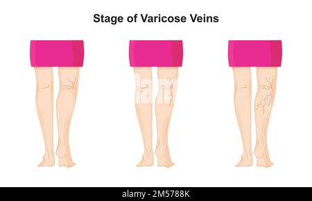 Stadium der Varizen Wissenschaftlichen Konzeption. Bunte Symbole. Vektordarstellung. Stock Vektor