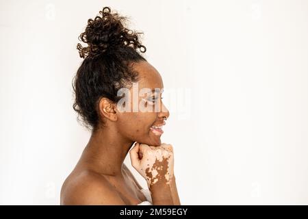 Seitenporträt einer jungen brasilianischen Frau mit Vitiligo im Gesicht und an den Händen, Nahaufnahme von Details des Mundes, geschlossene Augen und lockiges Haar, weißer Hintergrund, CO Stockfoto