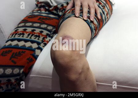 Blaue Flecken auf der Haut ihres Beins Stockfoto